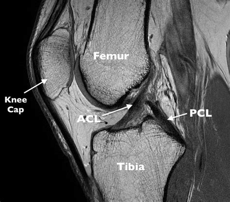 acl tear diagnostic test mri|acl tear mri vs normal.